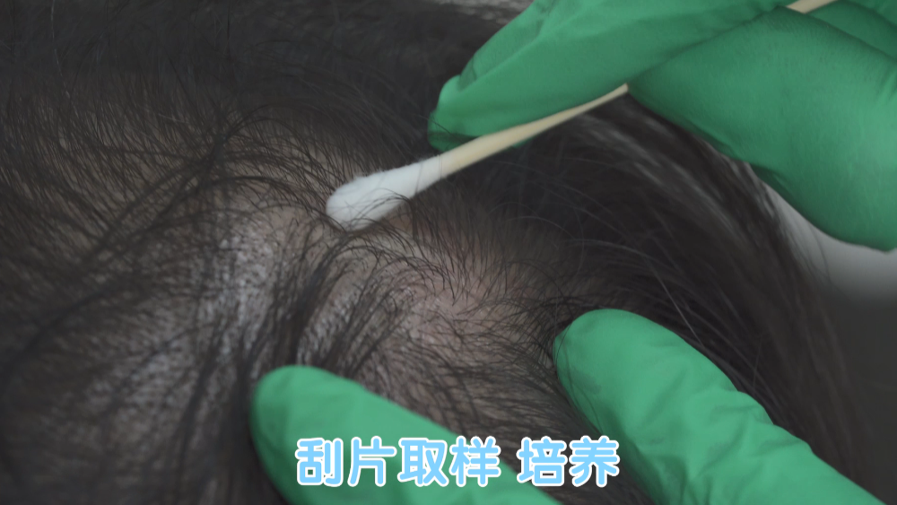 年纪轻轻的90后,竟然英年早秃了!实验告诉你,头发是怎么秃的! 年纪轻轻的90后,竟然英年早秃了!实验告诉你,头发是怎么秃的!