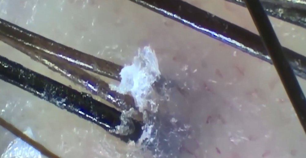 年纪轻轻的90后,竟然英年早秃了!实验告诉你,头发是怎么秃的! 年纪轻轻的90后,竟然英年早秃了!实验告诉你,头发是怎么秃的!